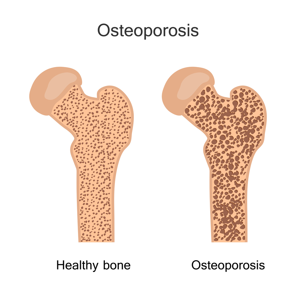 Get screened for osteoporosis using DEXA scans